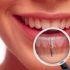 تعرف على عملية زراعة الأسنان أوغرس الأسنان